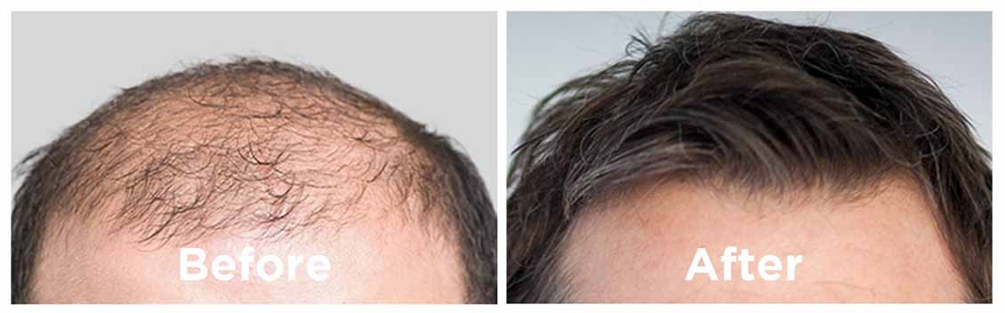 Hair Revital X results