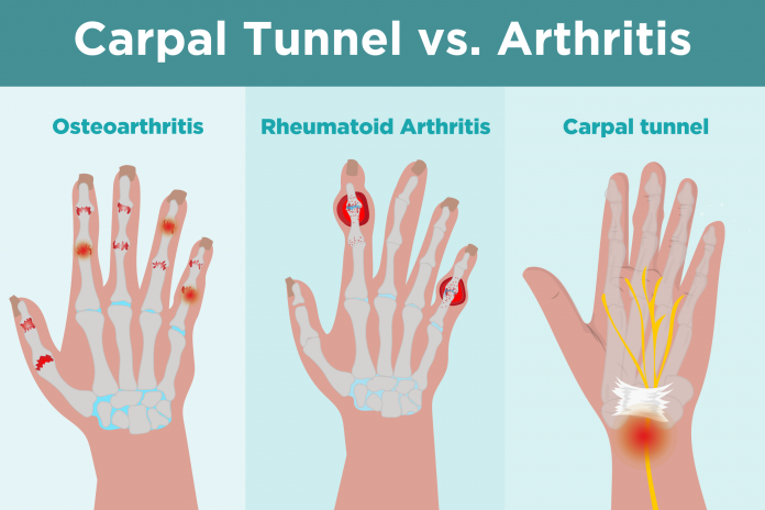 signs of carpal tunnel