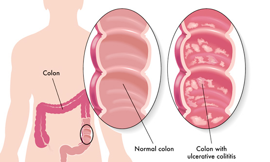 symptoms of ulcerative colitis