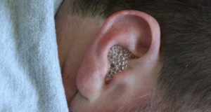 Hydrogen Peroxide In Ear 